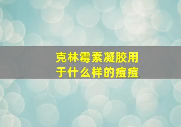 克林霉素凝胶用于什么样的痘痘